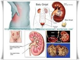 Illustration for article titled Ciri Penyakit Gagal Ginjal Kronis